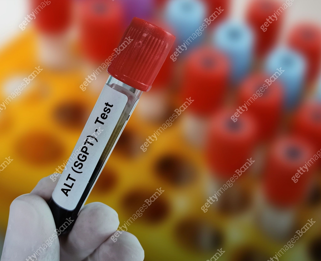 Blood sample for ALT (SGPT) test, liver function test. 이미지 (1438652967 ...