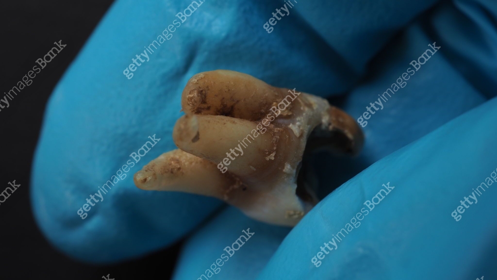 Tooth decay and dentist hand with glove and black background. Macro ...
