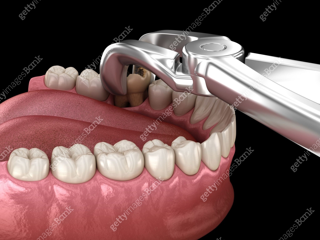 Extraction Of Molar Tooth Damaged By Caries Dental 3D Illustration extraction-of-molar-tooth-damaged-by-caries-dental-3d-illustration