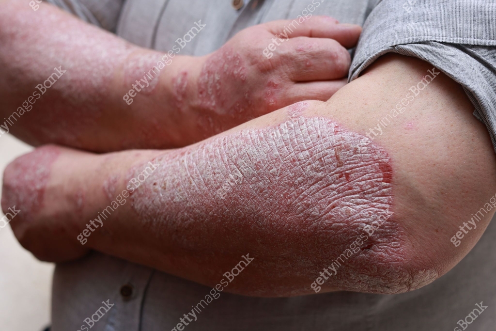 Psoriasis skin with red wounds. Male arms with cracked, hard, horny ...