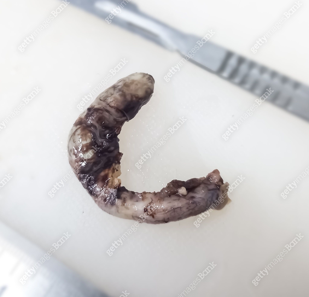 Normal Appendix Removed Appendix after surgery in histology lab. Intestine. Bowel, appendix ...