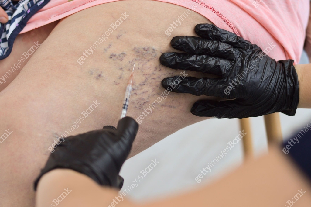 A doctor makes an injection to the varicose veins on a woman's leg 이미지 ...