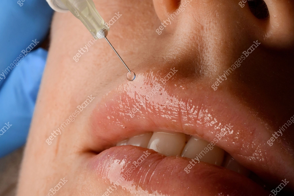 close-up of pink female lips and syringe needle with botox injection ...