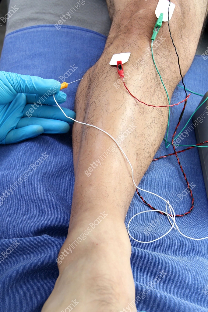 Electromyography EMG and Somatosensory Evoked Potential PEV of lower ...