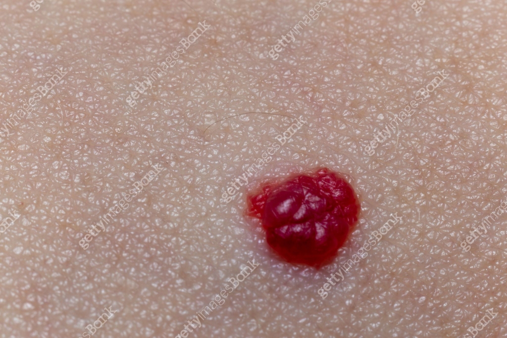 Red Mole On Skin Extreme Close up View 1482038826 red-mole-on-skin-extreme-close-up-view-1482038826