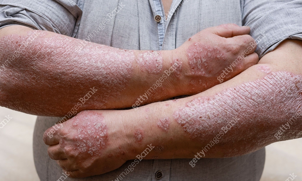 Psoriasis skin with red wounds. Male arms with cracked, hard, horny ...