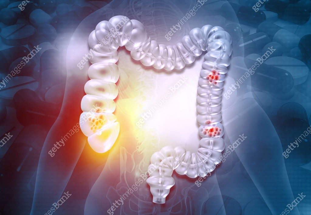 Human colon anatomy 이미지 (1494518895) 일러스트, 무료 일러스트 - 게티이미지뱅크