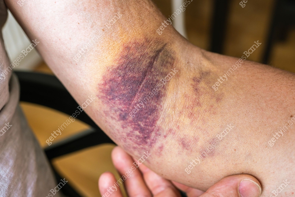 Left Arm With Rushes injury ligament arm bruise 이미지 (1560825445) - 게티이미지뱅크