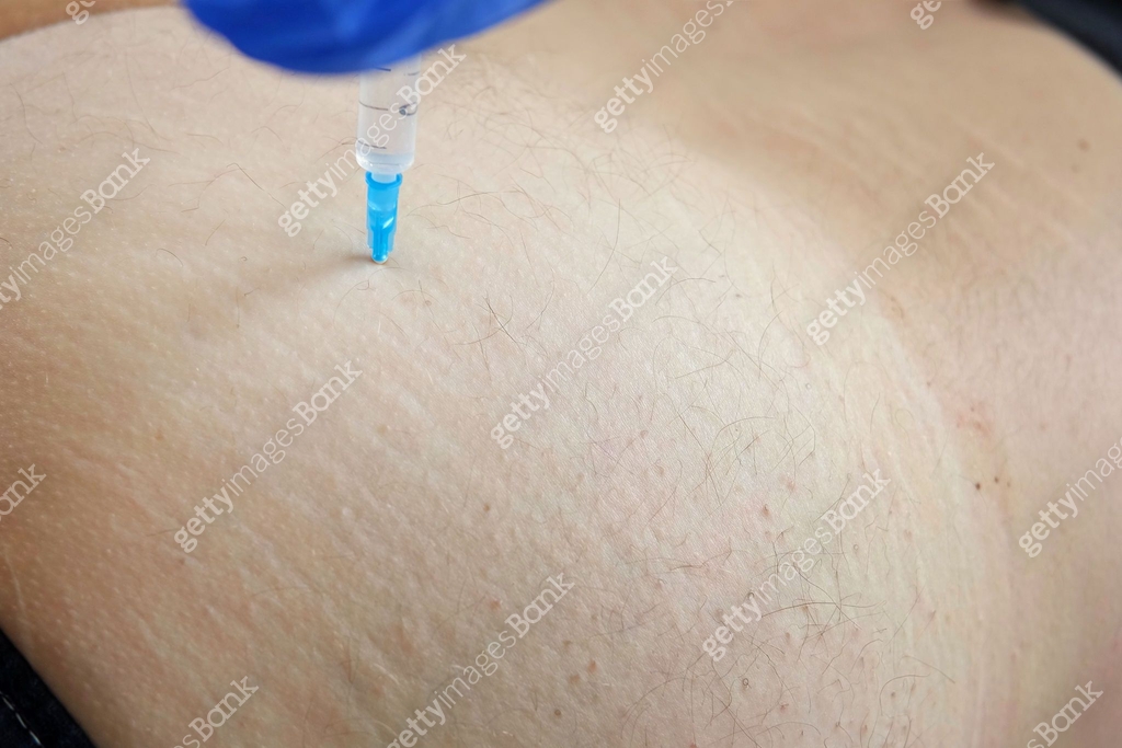 Needle injecting into the muscle. Nurse doing a trigger point injection ...