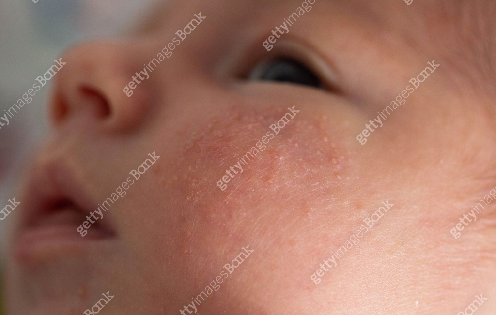 Rash on the face of a newborn baby. The process of formation of the ...