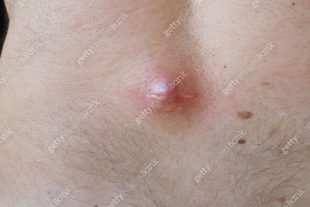 Abscess furuncle carbuncle on male hairy back. Clogged pore leading to ...