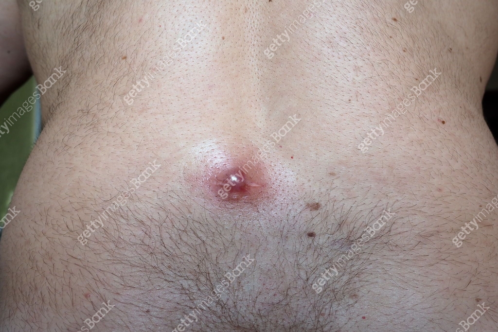 Abscess furuncle carbuncle on male hairy back. Clogged pore leading to ...