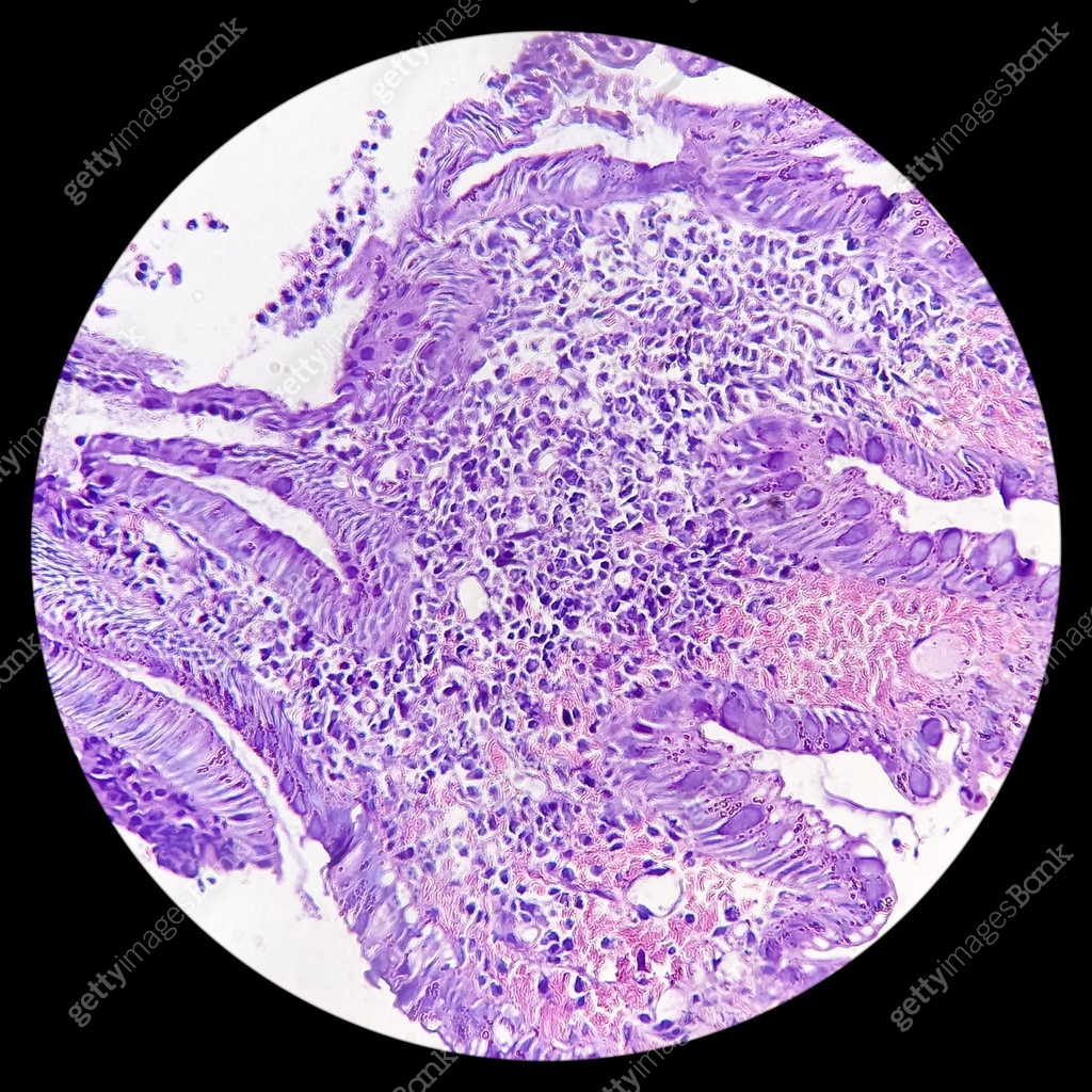 Colonoscopic Tree Sigmoid colon (colonoscopic biopsy): Chronic nonspecific colitis. Show ...