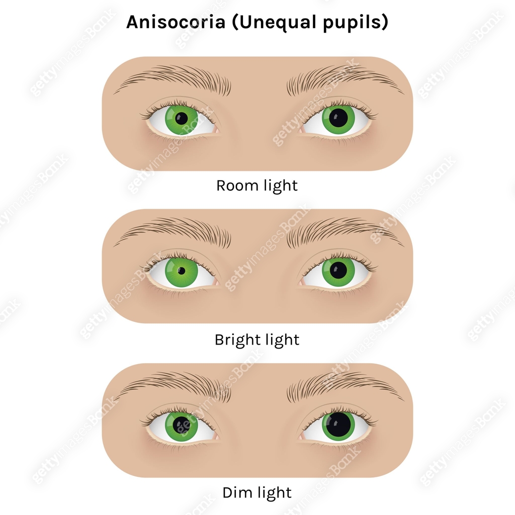 Realistic Human Eyes With Anisocoria Vector Illustration Design realistic-human-eyes-with-anisocoria-vector-illustration-design