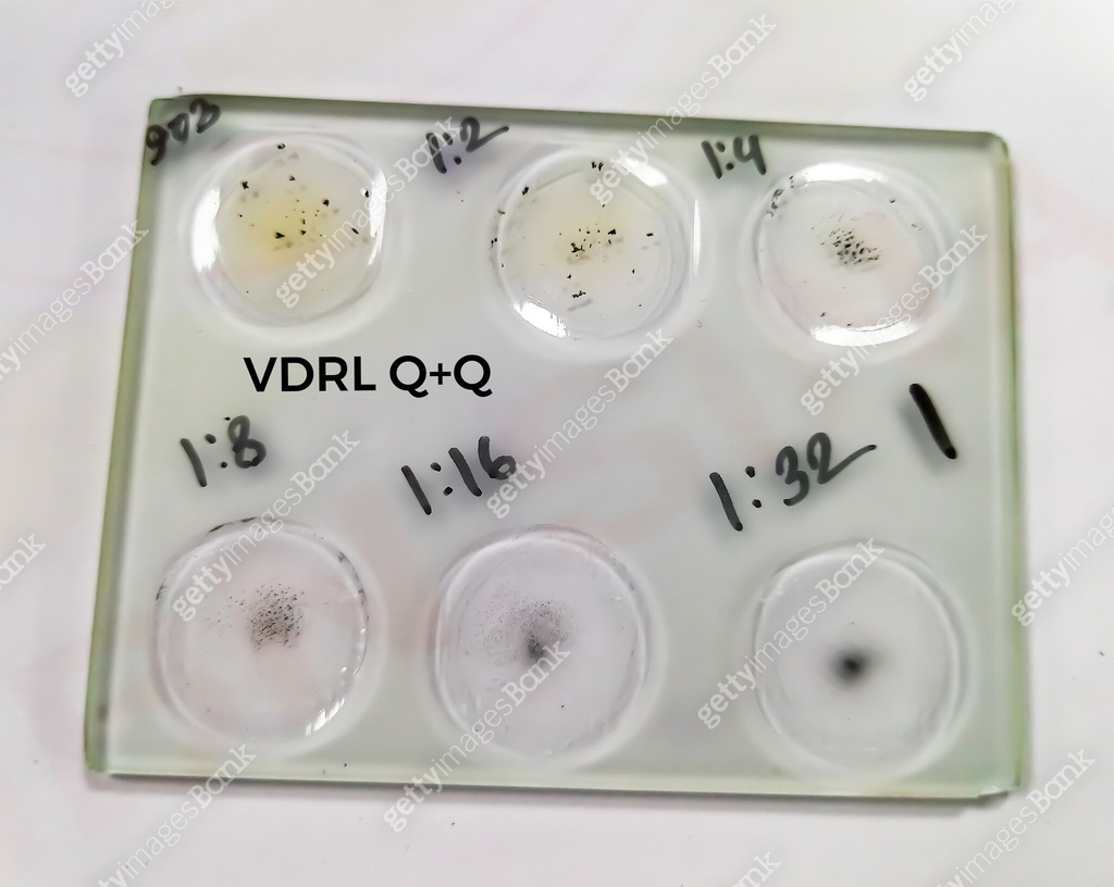 RPR, VDRL, Syphilis test glass slide agglutination method, showing ...