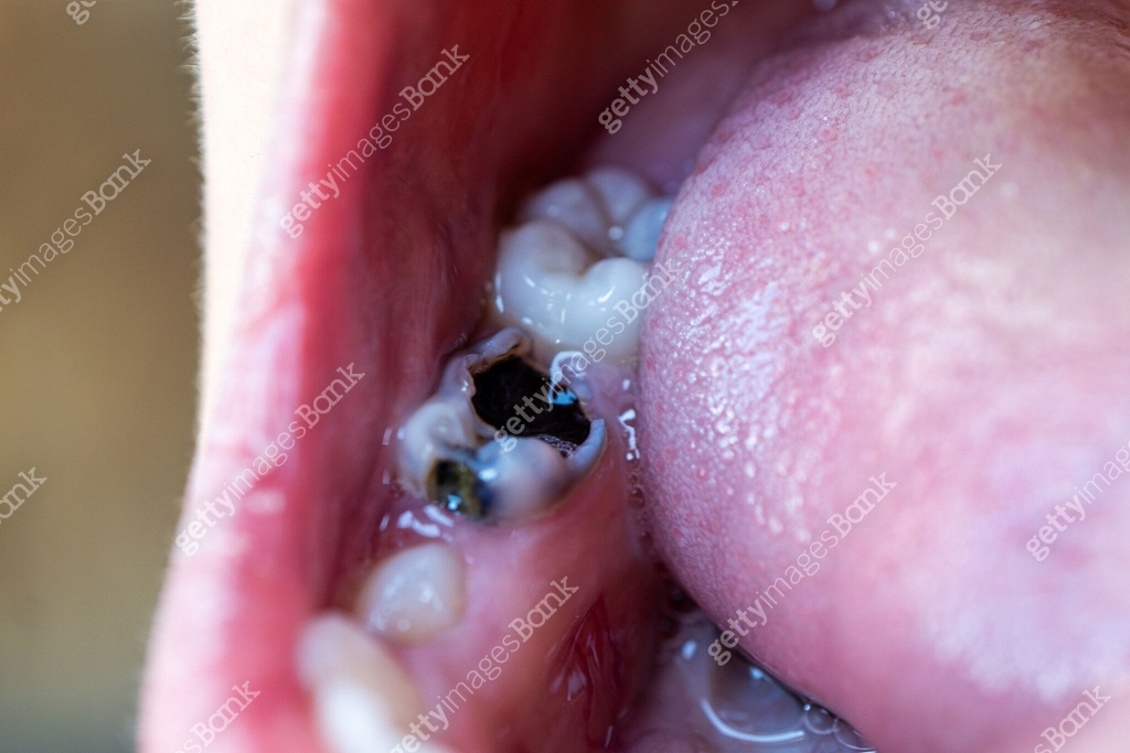 Toot Rotten Inside Unhealthy child's teeth with black plaque. Missing rotten teeth. a ...