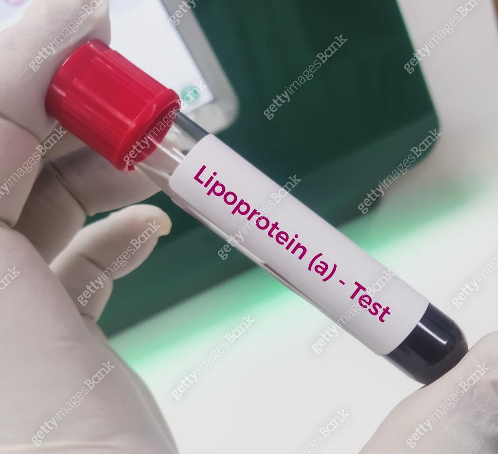 Blood Sample For Lipoprotein A LpA Test Lipid Profile To Diagnosis blood-sample-for-lipoprotein-a-lpa-test-lipid-profile-to-diagnosis