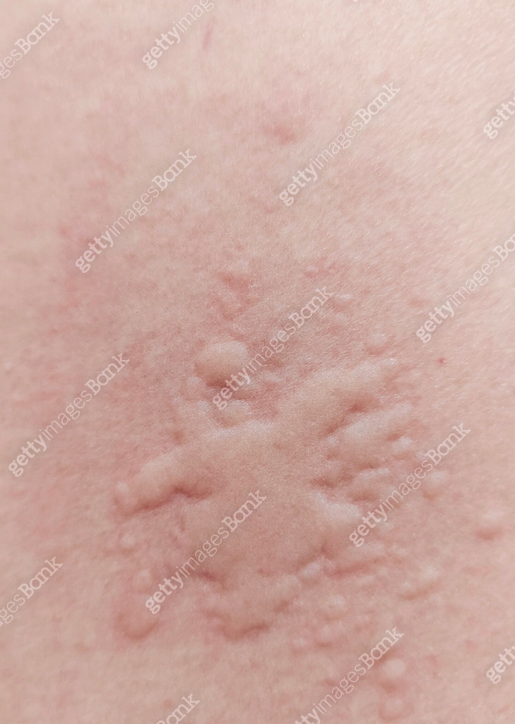 Red Tendril Rash Red rash on the skin caused by allergies. 이미지 (1974708574) - 게티이미지뱅크