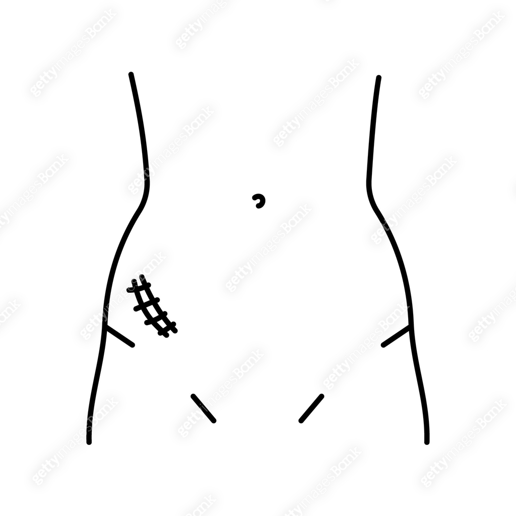 Mcburney incision line icon. Abdominal incisions. 이미지 (2093423458) 일러스트 ...