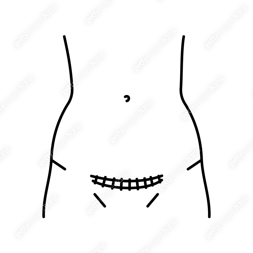 Pfannenstiel incision line icon. Abdominal incisions. 이미지 (2093423983 ...