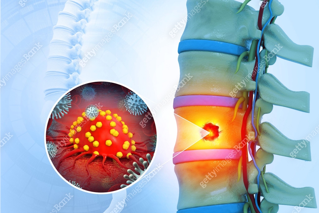Spine cancer or spinal tumor disease. 3d illustration 이미지 (2053066484 ...