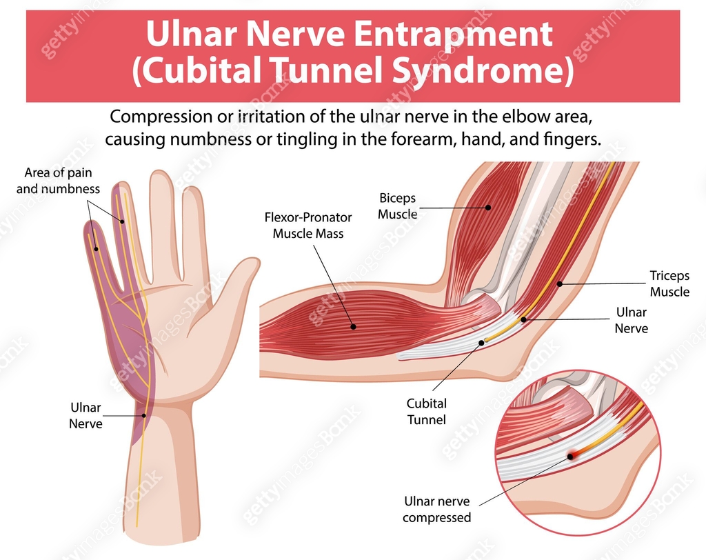 Detailed Diagram Of Cubital Tunnel Syndrome 2154430783 Detailed Diagram Of Cubital Tunnel Syndrome 2154430783