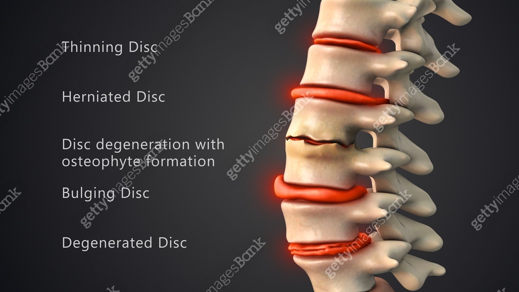 Difficulties with the human spinal discs 이미지 (2151358750) - 게티이미지뱅크