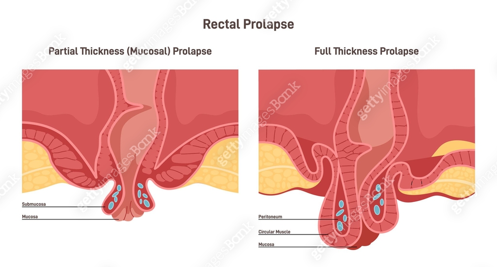 Proctocyle Rectum prolapse. Two types of proctological disease. Human anus 이미지 ...