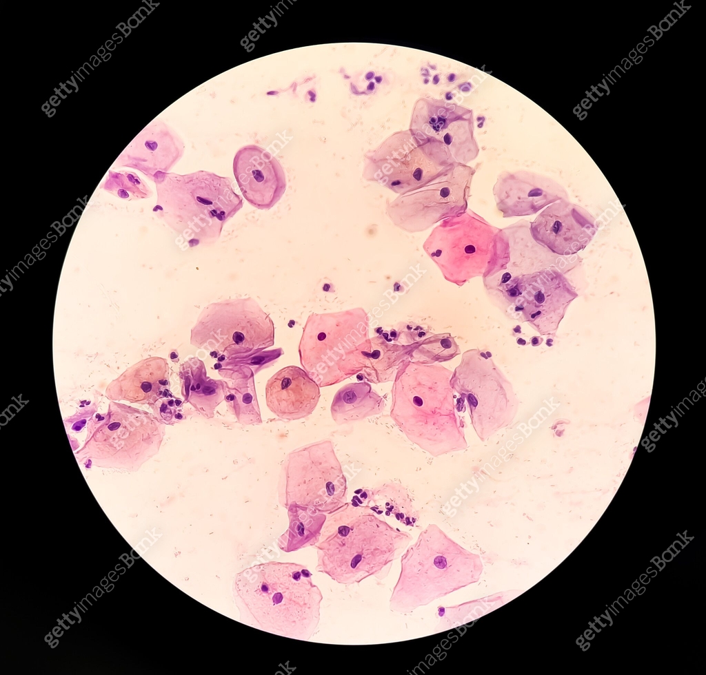 Atypical squamous cells of undetermined significance, it may be a sign ...