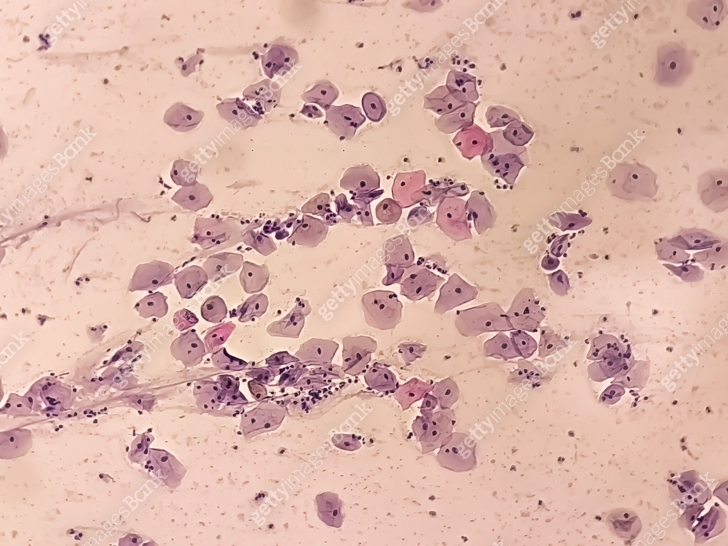 Atypical squamous cells of undetermined significance, it may be a sign ...