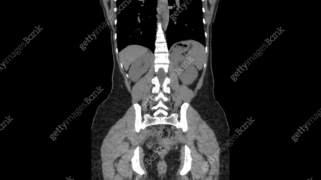 Normal Ct normal abdomen CT scan 이미지 (2160504657) - 게티이미지뱅크