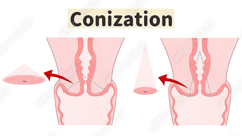 Cervical conization (Cone biopsy) diagram 이미지 (2158211588) 일러스트, 무료 ...