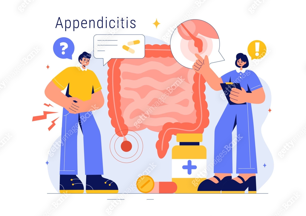 Appendicitis Vector Illustration Featuring Inflammation of the Appendix ...