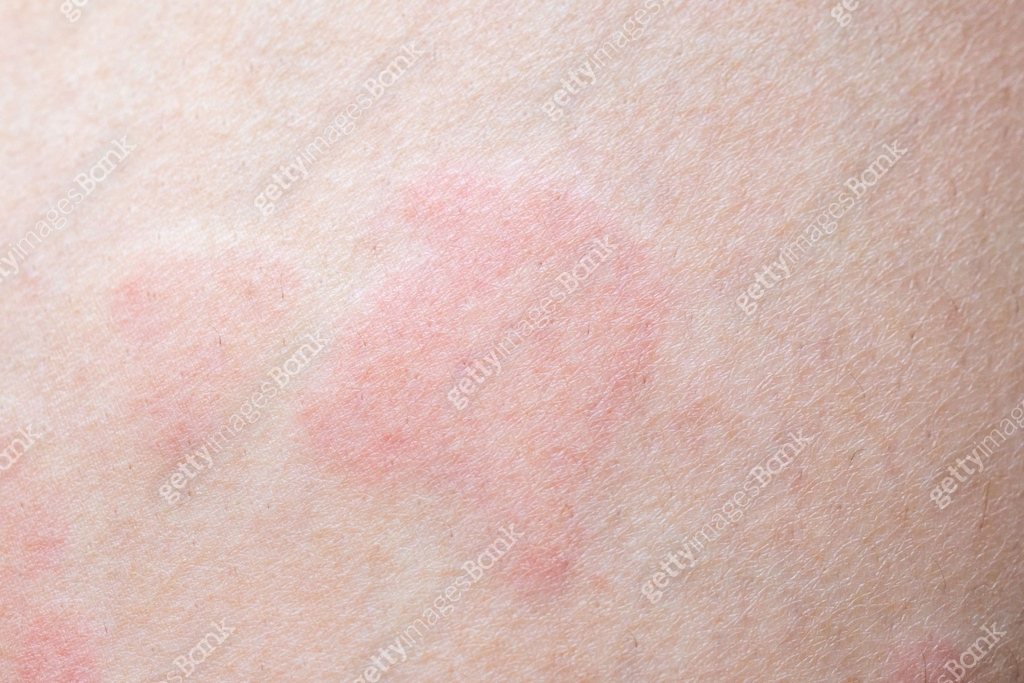 Rippled Texture Rash Skin allergy rash dermatitis texture close up 이미지 (2180109828) - 게티이미지뱅크