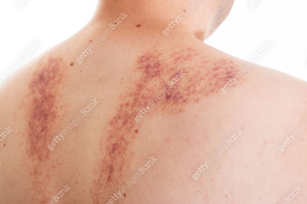 Pull Skin Back Marks on the skin of a man's back after a massage. Concept of improper ...