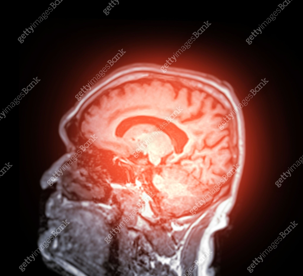 A normal contrast-enhanced MRI scan of the brain showing clear ...