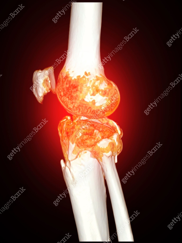 Trauma Case: Tibia and Fibula Fracture in 3D CT Scan A detailed 3D ...