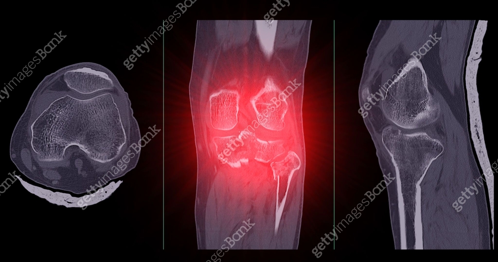 CT Imaging of Tibia and Fibula Fracture in Trauma Case A detailed CT ...