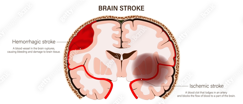 Brain stroke vector. Hemorrhagic stroke and Ischemic stroke. Brain ...